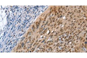 Immunohistochemistry of paraffin-embedded Human cervical cancer using MCM6 Polyclonal Antibody at dilution of 1:45