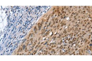 Immunohistochemistry of paraffin-embedded Human cervical cancer using MCM6 Polyclonal Antibody at dilution of 1:45 (MCM6 anticorps)