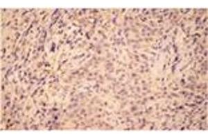 Immunohistochemistry analysis of human breast cancer tissue with HO-2 pAb. (HMOX2 anticorps  (N-Term))