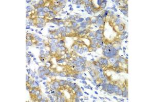 Immunohistochemistry of paraffin-embedded human gastric cancer using TFAM antibody at dilution of 1:100 (x40 lens). (TFAM anticorps)