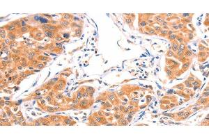 Immunohistochemistry of paraffin-embedded Human lung cancer using AMPD1 Polyclonal Antibody at dilution of 1:80 (AMPD1 anticorps)