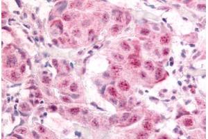 Human Breast Carcinoma (formalin-fixed, paraffin-embedded) stained with E2F1 antibody ABIN214450 at 10 ug/ml followed by biotinylated goat anti-rabbit IgG secondary antibody ABIN481713, alkaline phosphatase-streptavidin and chromogen. (E2F1 anticorps  (pSer364))
