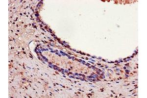 Immunohistochemistry of paraffin-embedded human prostate cancer using ABIN7154138 at dilution of 1:100 (GAPDH anticorps  (AA 3-335))