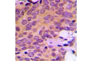 Immunohistochemical analysis of Ataxin 2 staining in human breast cancer formalin fixed paraffin embedded tissue section.