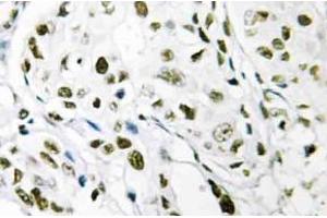 Immunohistochemistry (IHC) analyzes of Elongin A1 antibody in paraffin-embedded human breast carcinoma tissue. (TCEB3 anticorps)