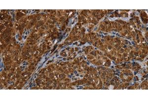 Immunohistochemistry of paraffin-embedded Human thyroid cancer using HSD17B13 Polyclonal Antibody at dilution of 1:30