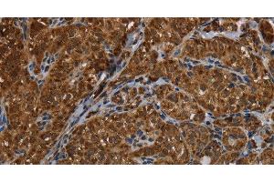 Immunohistochemistry of paraffin-embedded Human thyroid cancer using HSD17B13 Polyclonal Antibody at dilution of 1:30 (HSD17B13 anticorps)