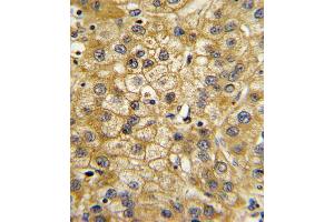 Formalin-fixed and paraffin-embedded human hepatocarcinoma with ADIPOR1 Antibody (C-term), which was peroxidase-conjugated to the secondary antibody, followed by DAB staining. (Adiponectin Receptor 1 anticorps  (C-Term))