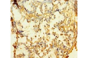 Immunohistochemistry of paraffin-embedded human breast cancer using ABIN7165112 at dilution of 1:100 (ATOH1 anticorps  (AA 1-354))