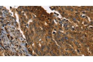 Immunohistochemistry of paraffin-embedded Human cervical cancer using PPIA Polyclonal Antibody at dilution of 1:35 (PPIA anticorps)