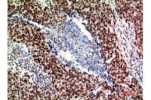 Immunohistochemistry (IHC) analysis of paraffin-embedded Human Breast Cancer, antibody was diluted at 1:200.