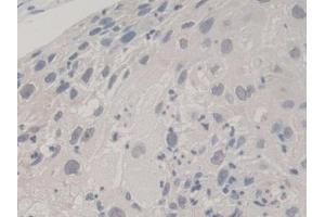 Detection of UBA52 in Human Lung cancer Tissue using Polyclonal Antibody to Ubiquitin A 52 Residue Ribosomal Protein Fusion Product 1 (UBA52)