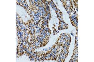 Immunohistochemistry of paraffin-embedded human gastric cancer using MRPL28 antibody.