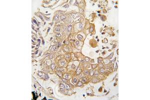 Formalin-fixed and paraffin-embedded human lung carcinoma tissue reacted with CYP1A1 antibody (C-term), which was peroxidase-conjugated to the secondary antibody, followed by DAB staining.