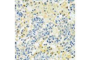 Immunohistochemistry of paraffin-embedded human lung cancer using SLC25A1 antibody (ABIN4905187) at dilution of 1:100 (40x lens). (Slc25a1 anticorps)
