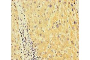 Immunohistochemistry of paraffin-embedded human liver cancer using ABIN7173655 at dilution of 1:100 (TUBA1B anticorps  (AA 29-310))