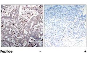 Immunohistochemical analysis of paraffin-embedded human breast carcinoma tissue using NFKBIB polyclonal antibody . (NFKBIB anticorps)