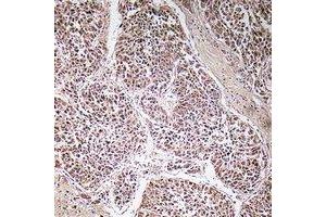 Immunohistochemical analysis of ATP5C1 staining in human liver cancer formalin fixed paraffin embedded tissue section. (ATP5C1 anticorps)