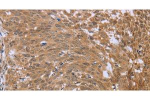 Immunohistochemistry of paraffin-embedded Human cervical cancer using FHL2 Polyclonal Antibody at dilution of 1:40