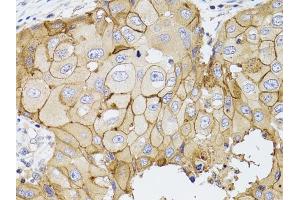 Immunohistochemistry of paraffin-embedded human breast cancer using PDE4D antibody (ABIN3022336, ABIN3022337, ABIN3022338 and ABIN6218749) at dilution of 1:100 (40x lens). (PDE4D anticorps  (AA 249-518))