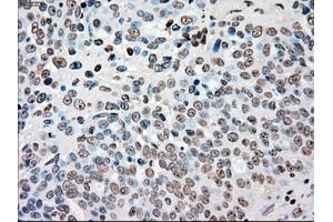 Immunohistochemical staining of paraffin-embedded colon tissue using anti-CHEK2mouse monoclonal antibody. (CHEK2 anticorps)