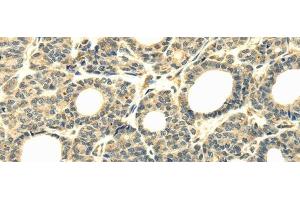 Immunohistochemistry of paraffin-embedded Human thyroid cancer tissue using WDR45B Polyclonal Antibody at dilution 1:40 (WD Repeat Domain 45B (WDR45B) anticorps)