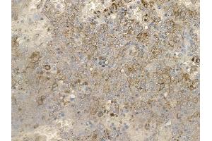 ABIN6256249 and ABIN6267164 at 1/100 staining human melanoma by IHC-P.