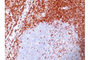 Formalin-fixed, paraffin-embedded human Non-Hodgkin's Lymphoma stained with Bcl-2 Mouse Monoclonal Antibody (SPM117). (Bcl-2 anticorps  (AA 41-54))