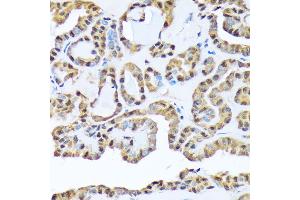 Immunohistochemistry of paraffin-embedded human thyroid cancer using FKBP51/FKBP5 Rabbit mAb (ABIN7267213) at dilution of 1:100 (40x lens). (FKBP5 anticorps)