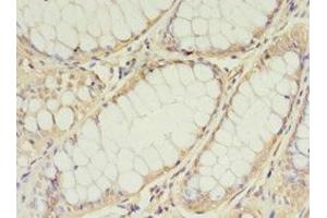 Immunohistochemistry of paraffin-embedded human colon cancer using ABIN7159891 at dilution of 1:100 (TIMM10 anticorps  (AA 1-90))