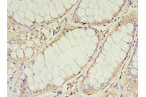 Immunohistochemistry of paraffin-embedded human colon cancer using ABIN7159891 at dilution of 1:100 (TIMM1 (AA 1-90) anticorps)