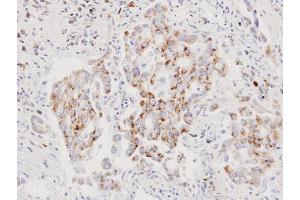 IHC-P Image Immunohistochemical analysis of paraffin-embedded human lung cancer, using AIF, antibody at 1:100 dilution.