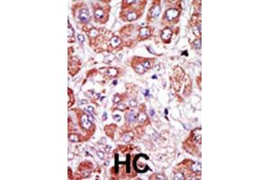 Immunohistochemistry (IHC) image for anti-Plasminogen Activator, Urokinase Receptor (PLAUR) antibody (ABIN3003728) (PLAUR anticorps)