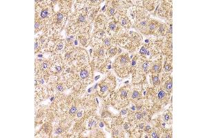 Immunohistochemistry of paraffin-embedded Human liver injury using ST3GAL3 antibody at dilution of 1:100 (x400 lens). (ST3GAL3 anticorps)
