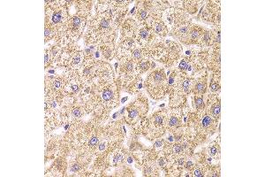 Immunohistochemistry of paraffin-embedded Human liver injury using ST3GAL3 antibody at dilution of 1:100 (x400 lens). (ST3GAL3 anticorps)