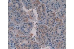 IHC-P analysis of Human Liver Cancer Tissue, with DAB staining. (MUC16 anticorps  (AA 13977-14117))