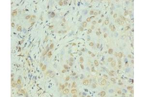 Immunohistochemistry of paraffin-embedded human liver cancer using ABIN7156933 at dilution of 1:100 (IL-8 anticorps  (AA 23-99))