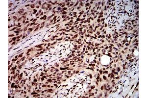 Immunohistochemical analysis of paraffin-embedded cervical cancer tissues using DDX1 mouse mAb with DAB staining. (DDX1 anticorps  (AA 642-740))