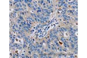 Immunohistochemistry of Human lung cancer using GRIA3 Polyclonal Antibody at dilution of 1:50 (Glutamate Receptor 3 anticorps)