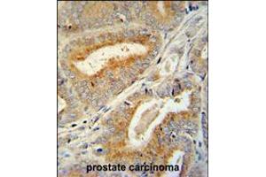 BCORL1 antibody immunohistochemistry analysis in formalin fixed and paraffin embedded human prostate carcinoma followed by peroxidase conjugation of the secondary antibody and DAB staining.