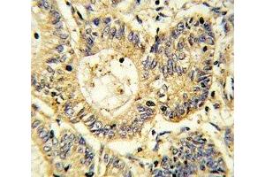 IHC analysis of FFPE human colon carcinoma stained with SOCS1 antibody