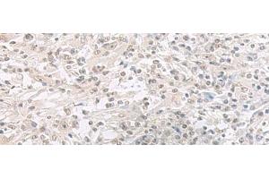 Immunohistochemistry of paraffin-embedded Human liver cancer tissue using ORC1 Polyclonal Antibody at dilution of 1:65(x200) (ORC1 anticorps)
