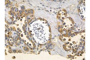 5 Lipoxygenase Mouse Monoclonal Antibody at 1/100 staining human ovarian cancer by IHC-P.
