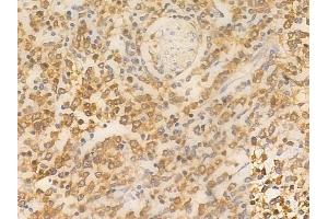 ABIN6260894 and ABIN6266702 at 1/100 staining human Hodgkin lymphoma by IHC-P. (CLOCK anticorps  (Internal Region))
