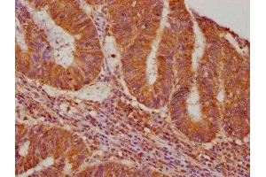 IHC image of ABIN7140215 diluted at 1:640 and staining in paraffin-embedded human colon cancer performed on a Leica BondTM system.