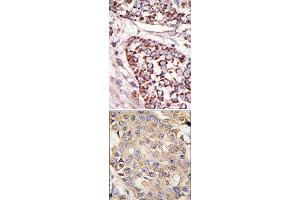 (TOP)Formalin-fixed and paraffin-embedded human cancer tissue reacted with the primary antibody, which was peroxidase-conjugated to the secondary antibody, followed by DAB staining. (ERK1 anticorps  (N-Term))