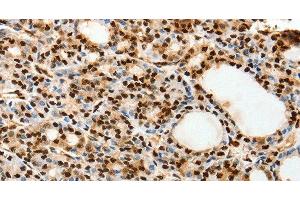 Immunohistochemistry of paraffin-embedded Human thyroid cancer using SPATA20 Polyclonal Antibody at dilution of 1:70 (SPATA20 anticorps)