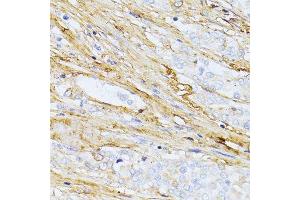 Immunohistochemistry of paraffin-embedded human colon carcinoma using TGFBI antibody.