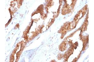 Formalin-fixed, paraffin-embedded human Prostate stained with HSP27 Mouse Monoclonal Antibody (CPTC-HSPB1-2).