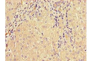 Immunohistochemistry of paraffin-embedded human liver cancer using ABIN7159734 at dilution of 1:100